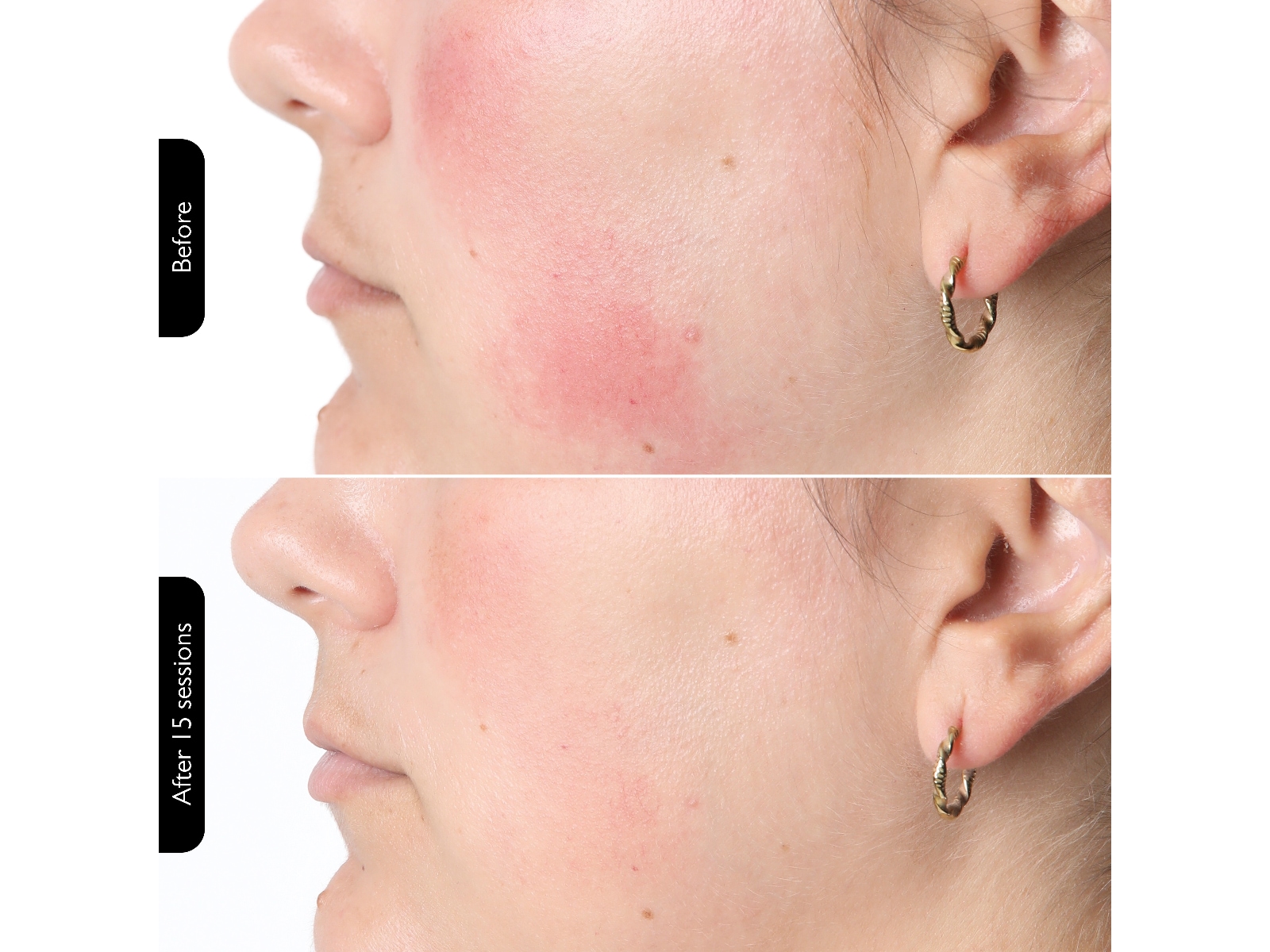 Silk'n Facial LED Mask Ansiktsbehandling