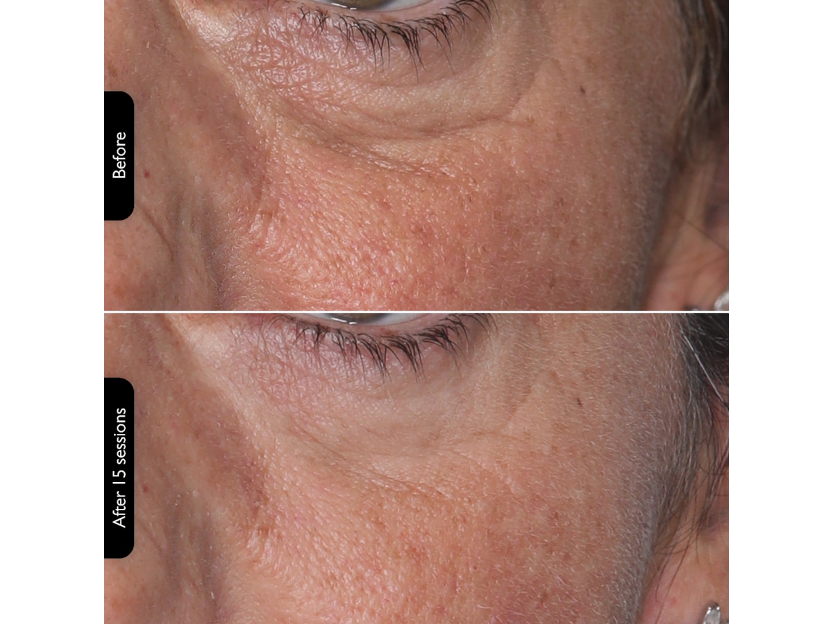 Silk'n Facial LED Mask Ansiktsbehandling