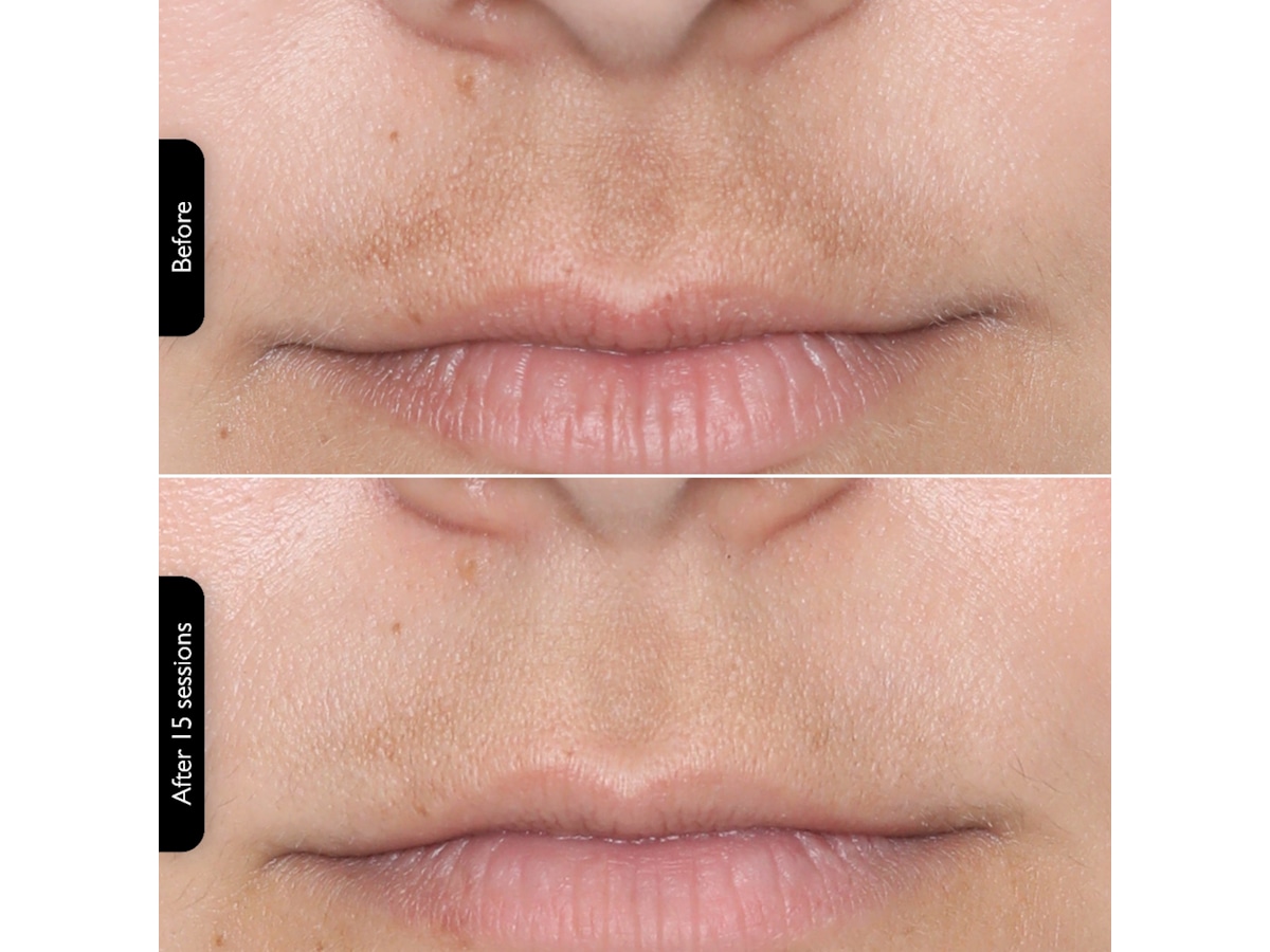 Silk'n Facial LED Mask Ansiktsbehandling