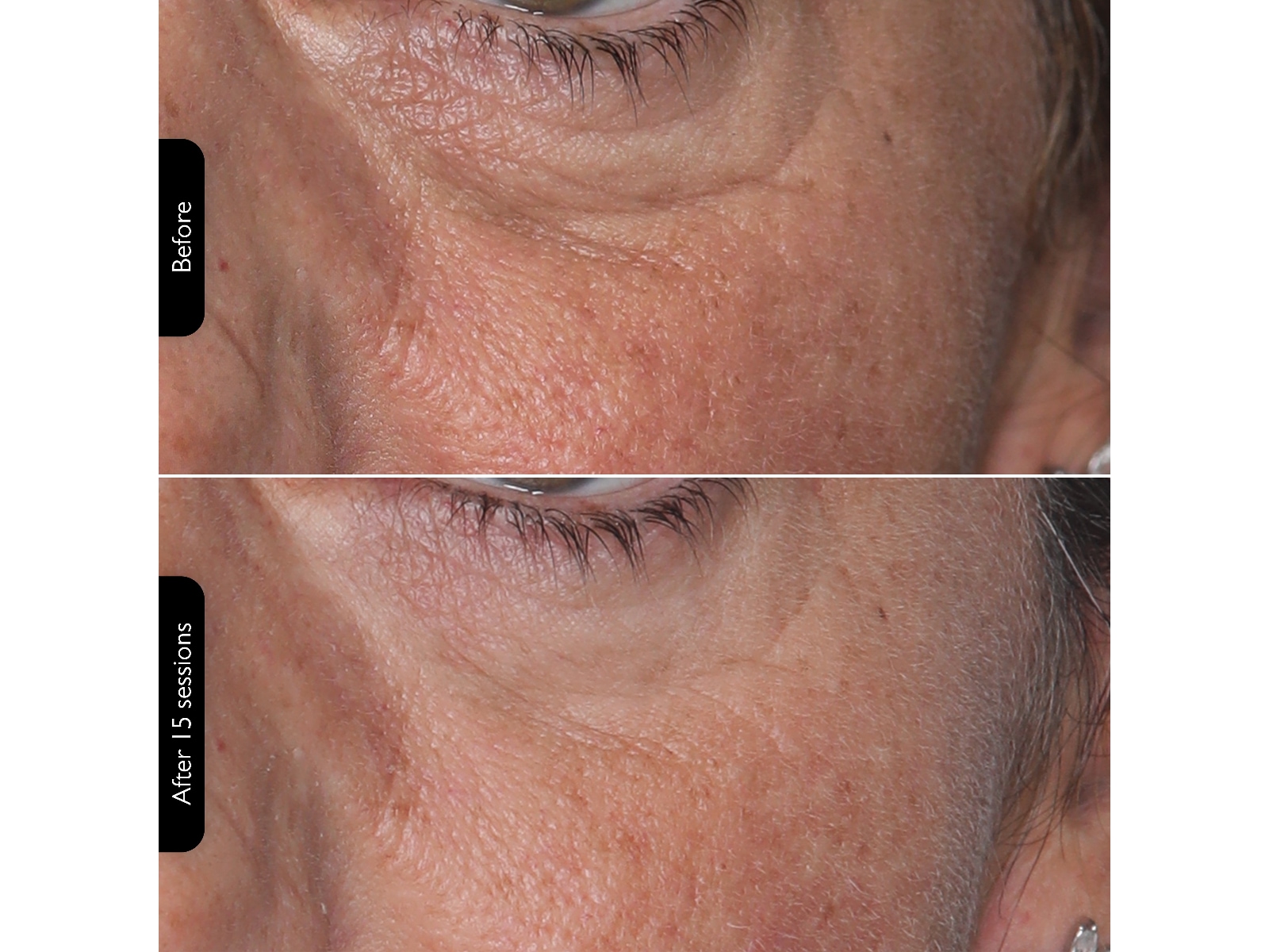 Silk'n Facial LED Mask Ansiktsbehandling