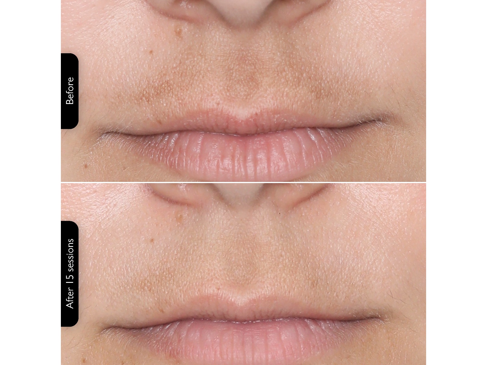 Silk'n Facial LED Mask Ansiktsbehandling