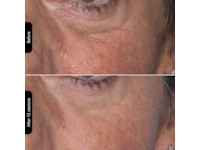 Silk'n Facial LED Mask Ansiktsbehandling