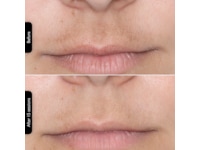 Silk'n Facial LED Mask Ansiktsbehandling